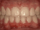 After braces with Dr Kanani Orthodontist